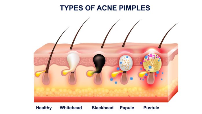 What are blackheads vs whiteheads and acne