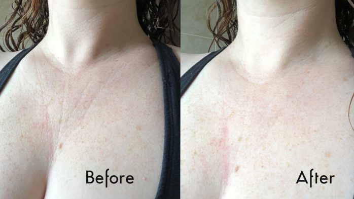Anew Skin Reset Plumping Shots review before and after chest