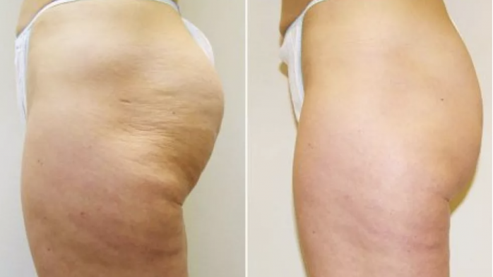 how to get rid of cellulie and cellulite treatment