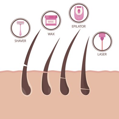 How does hair removal work?