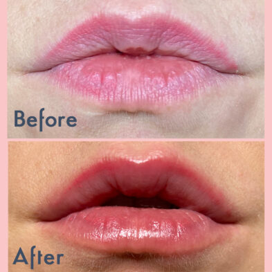 Lip plumper before and after LipMD