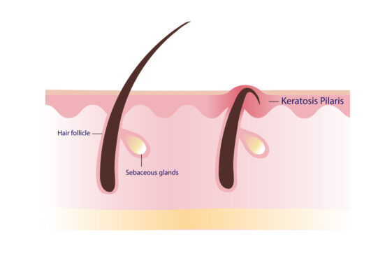 What is Keratosis Pilaris and how to get rid of chicken skin