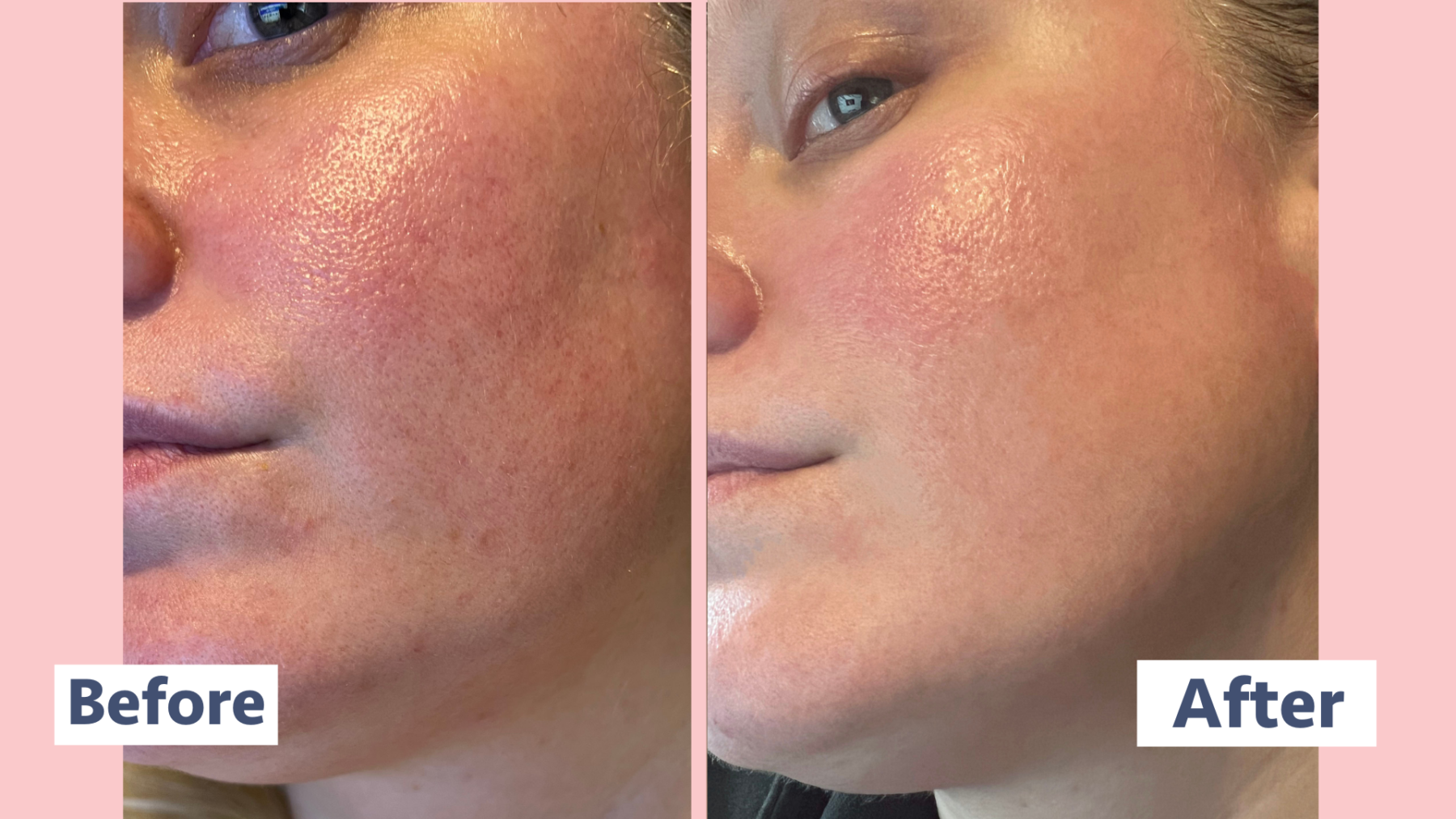 Paula's Choice BHA Exfoliant review: Before and After - mamabella