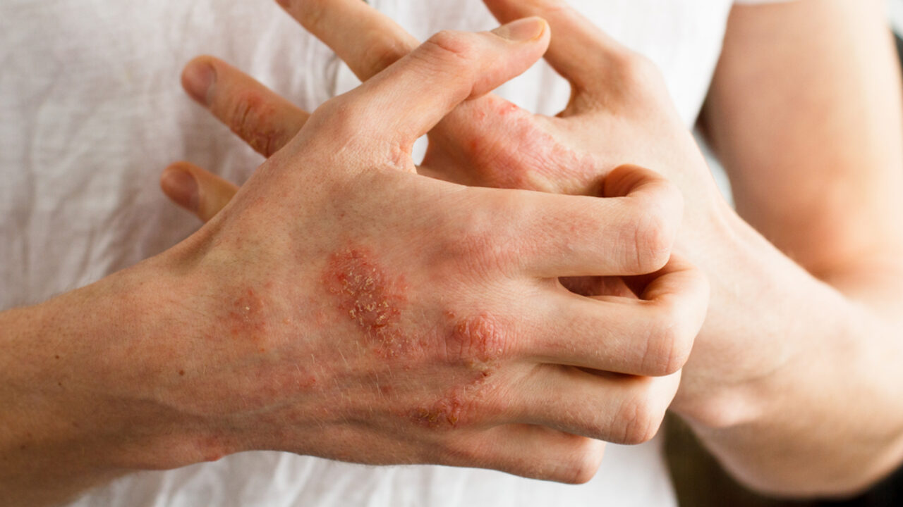 What is psoriasis, what causes it and can you cure it permanently