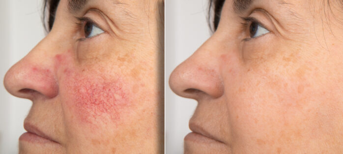 What is rosacea, what the symptoms and triggers and how to get rid of rosacea permanently